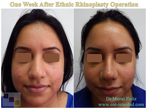 Rhinoplasty Healing Properties by Week and Month