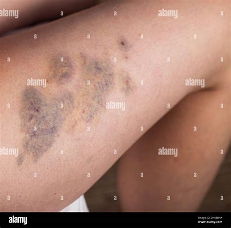 Can I Massage Bruise at Paul Hines blog