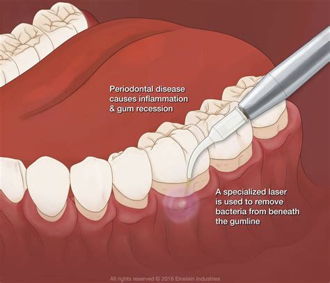 Gum Infection And Treatment