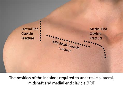 Clavicle – Cambridge Shoulder