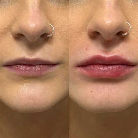 Pinterest | Natural lips, Botox lips, Lip fillers