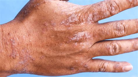 Eczema Treatment in Dublin | Dermatological Eczema Care - Refine Clinic