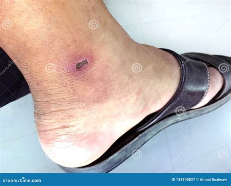 Lesion Scab Dried on the Epidermis Skin Ankle, Lesion, Dermatitis, Dark ...