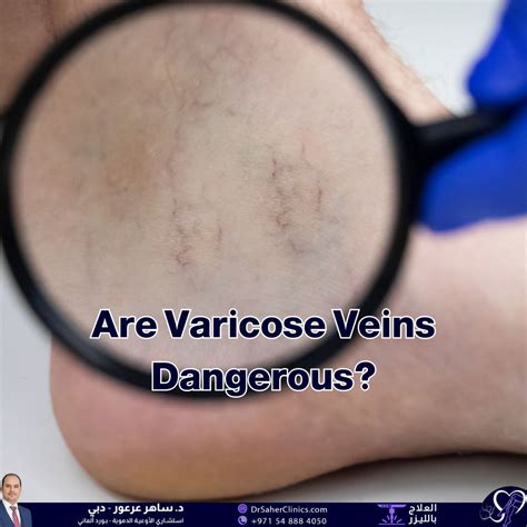 Are Varicose Veins Dangerous?