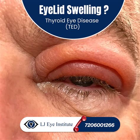 Oculoplasty - LJ Eye Institute