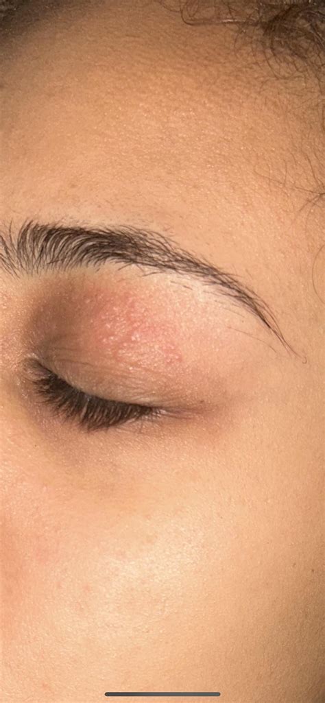 Small rash on eyelid : r/skin