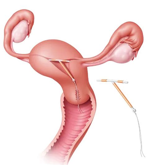 IUD contraceptive device, types, insertion, removal, risks & side effects