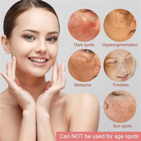 Dark Spot Remover for Face and Body - Melasma, Sun Spots, Freckle ...