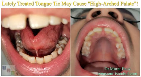 Causes, Symptoms and Treatment of "High-Arched Palate"