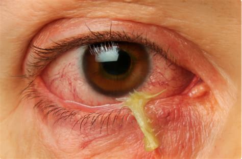 How to Get Rid of Eye Mucus: Causes & Remedies