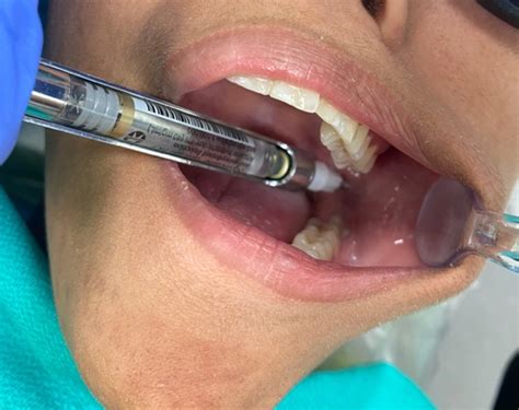 Inferior Alveolar Nerve Block - Local Anesthesia in Pediatric Dentistry ...