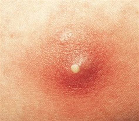 White Pimples On Vag Lips | Lipstutorial.org