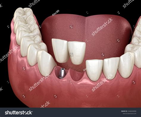 Cantilever Bridge Dental