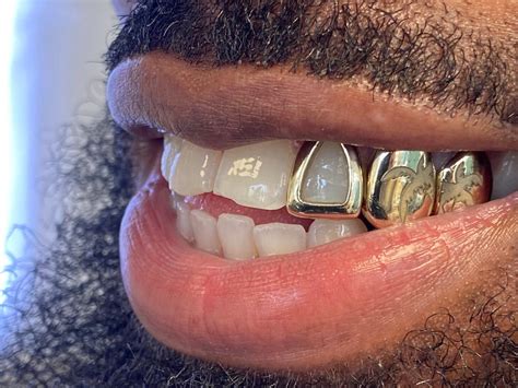Custom Fitted Gold Window Grillz: Open Face Tooth Cap - Etsy