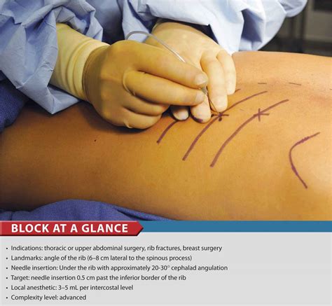 Intercostal Nerve Block