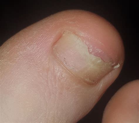 Onychomycosis (ICD-10. B35) - Online consultation AI dermatologist