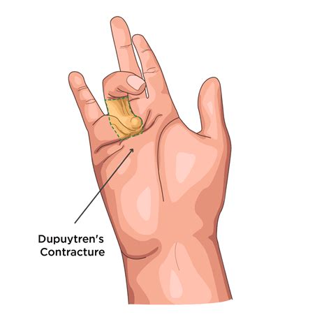 Hand & Wrist Surgery in Leeds - Skin Surgery Clinic