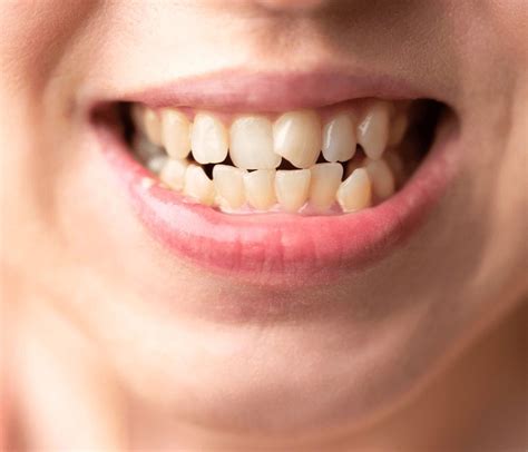 What is a Canine Tooth? Everything You Need To Know