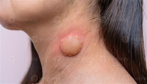 Boil Or Pimple