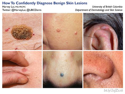 Overview Of Benign Skin Lesions: Common Lesions And Management - YDCISN
