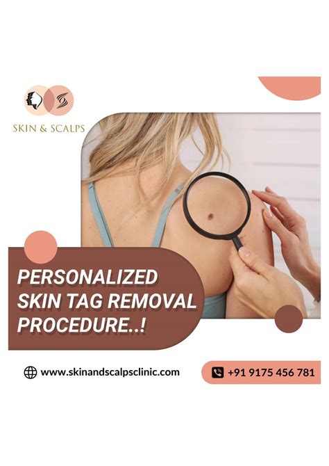 Personalized Skin Tag Removal Procedure! by Skin and Scalps Clinic - Issuu