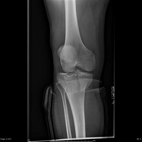 Tibial Plateau Fractures - Trauma - Orthobullets