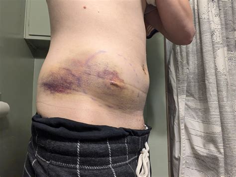 Hematoma After Operation