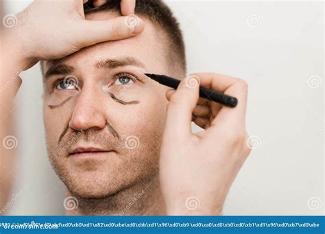 Close-up Male Blepharoplasty for Man Markup on the Face before Plastic Surgery Operation for ...