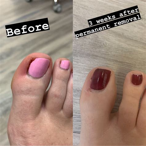 Mild Ingrown Toenail