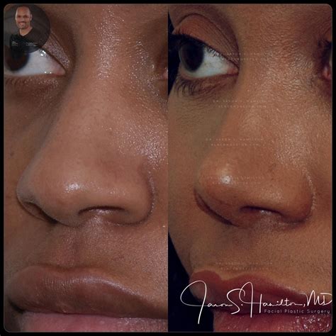 African American Rhinoplasty Los Angeles Black Nose Surgery | Nose surgery, Nose job, Rhinoplasty
