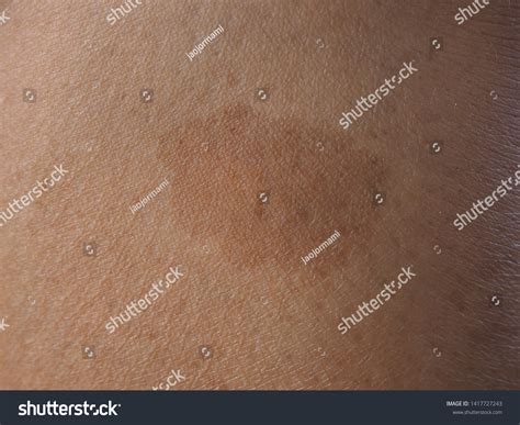 Dark Brow Birthmark Cafe Au Lait Stock Photo 1417727243 | Shutterstock
