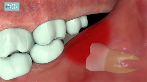 Dolor De Muela Del Juicio