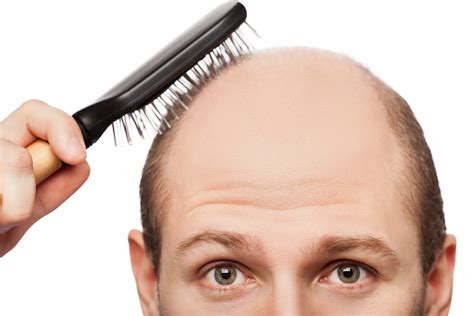 New rare gene discovery provides further insights into male hair loss