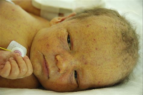 Congenital Rubella Blueberry Muffin Rash