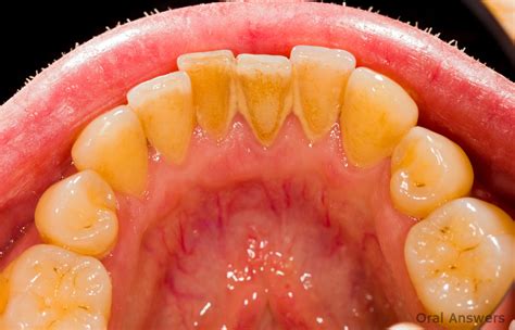 Causes Of Black Plaque On Teeth at Jasper Gunson blog