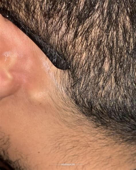 Why Do I Have A Hard Lump Behind My Ear - Infoupdate.org