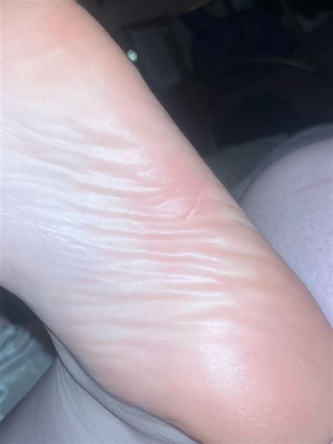 Itchy spot on bottom of foot (23F, 4’11 200lbs) : r/DiagnoseMe
