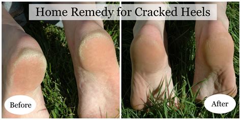 Home Remedy for Cracked Heels - Saving Cent by Cent
