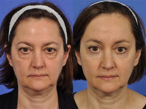 Brow Lift in Philadelphia, PA | Brow Lift Plymouth Meeting | W Cosmetic Surgery™