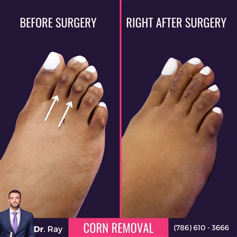 What to Know About Corn Removal Surgery Before And After