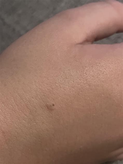 Smooth skin colored bump with black dot on 12yo hand : r/DermatologyQuestions