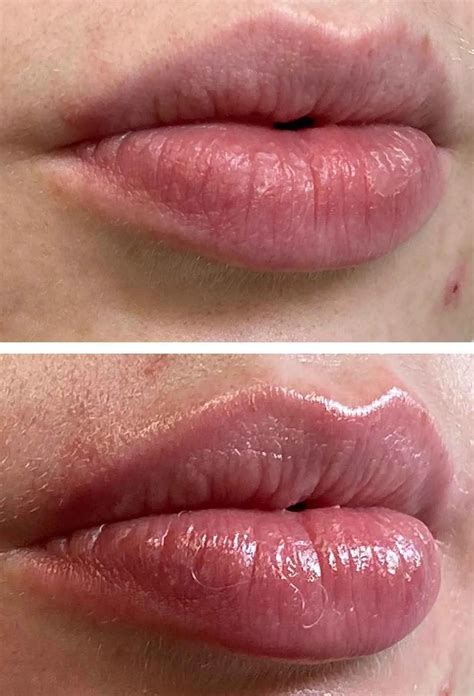 The Truth About Microneedling Your Lips