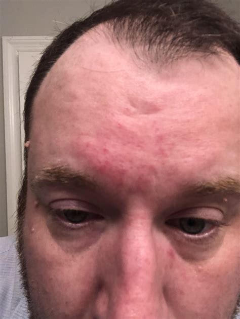 What Does Red Dot Forehead Mean at Hugo Bergin blog