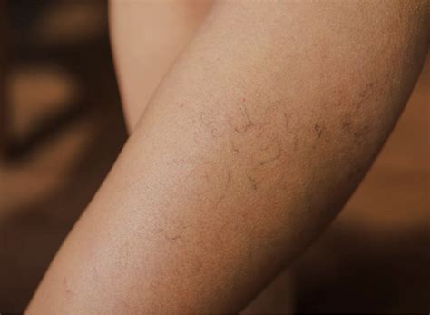 Non Cancerous Lesions Skin - Benign Growth on Skin | rtwskin