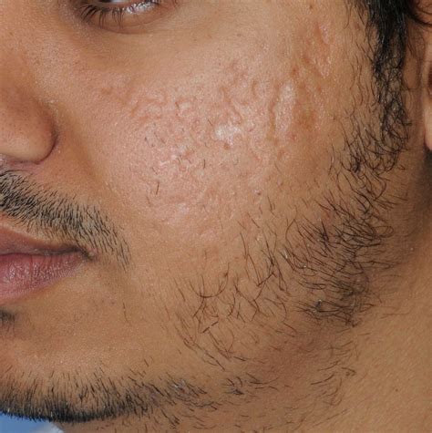 Acne Scars And Treatment at Lloyd Sutton blog