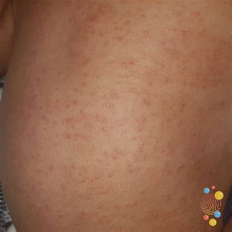 Viral Rash Exanthem Wikipedia