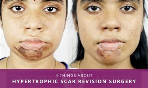 Four Things You Must Know About Hypertrophic Scar Revision Surgery ...