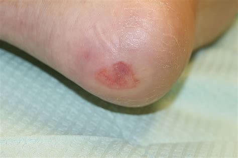 Diabetic Foot Ulcer Wagner Classification