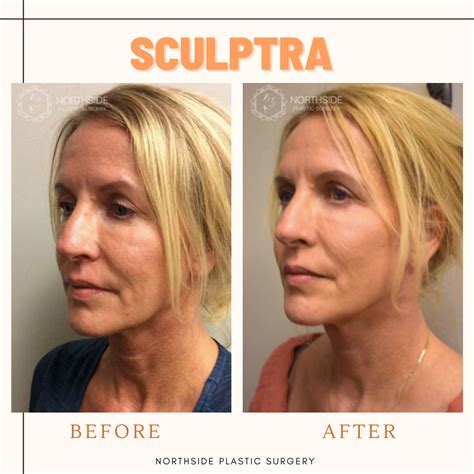 ⭐️Sculptra before and after ⭐️ . Sculptra is not just a wrinkle filler; it is also a facial ...