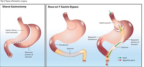 Two Common Types Of Gastric Bypass Surgery to be Considered